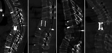 Risk Factors for Poor Matching of Intervertebral Fusion Devices After Posterior Vertebral Column Resection in Patients With Kyphosis or Kyphoscoliosis.
