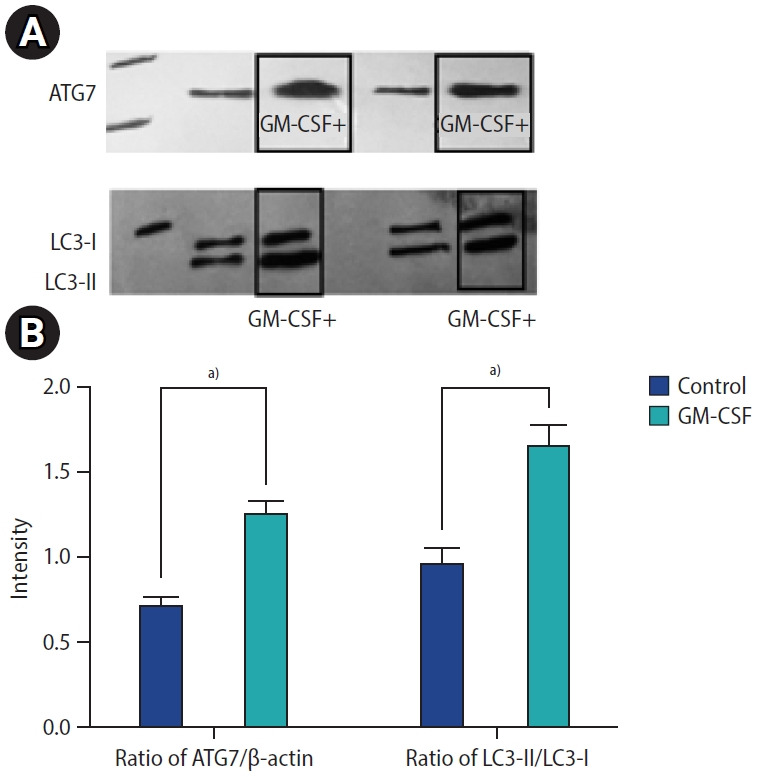 The role of granulocyte-macrophage colony-stimulating factor in inducing autophagy in the spermatozoa of patients with asthenoteratozoospermia.
