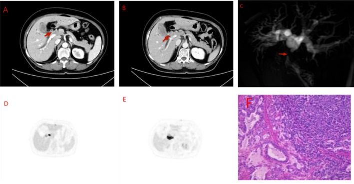 Mixed Neuroendocrine-Non-Neuroendocrine Tumor of Bile Duct.