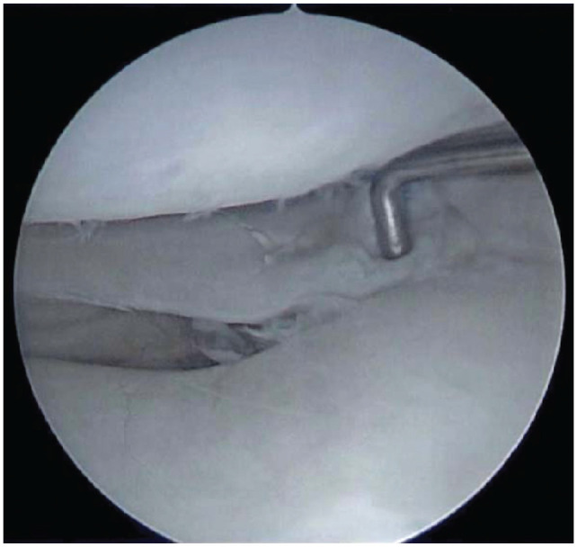 Evaluation of Outcomes at Mean 4.8 Years After Repair of Types 3 and 4 Lateral Meniscal Oblique Radial Tears during ACL Reconstruction.