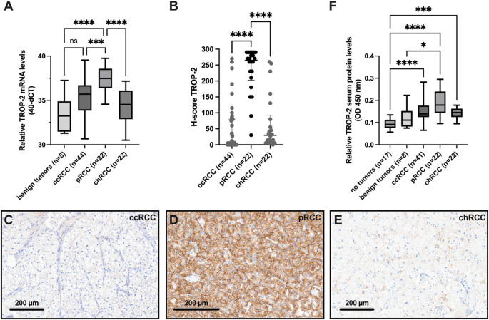 TROP-2 overexpression in papillary renal cell carcinoma supports its potential as a therapeutic target for antibody-drug-conjugate therapy.