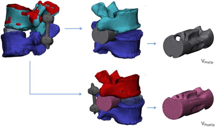 Evaluation of Indirect Decompression Effect After Extreme Lateral Lumbar Interbody Fusion Using Three-Dimensional Volumetric Measurements-A Retrospective Study.