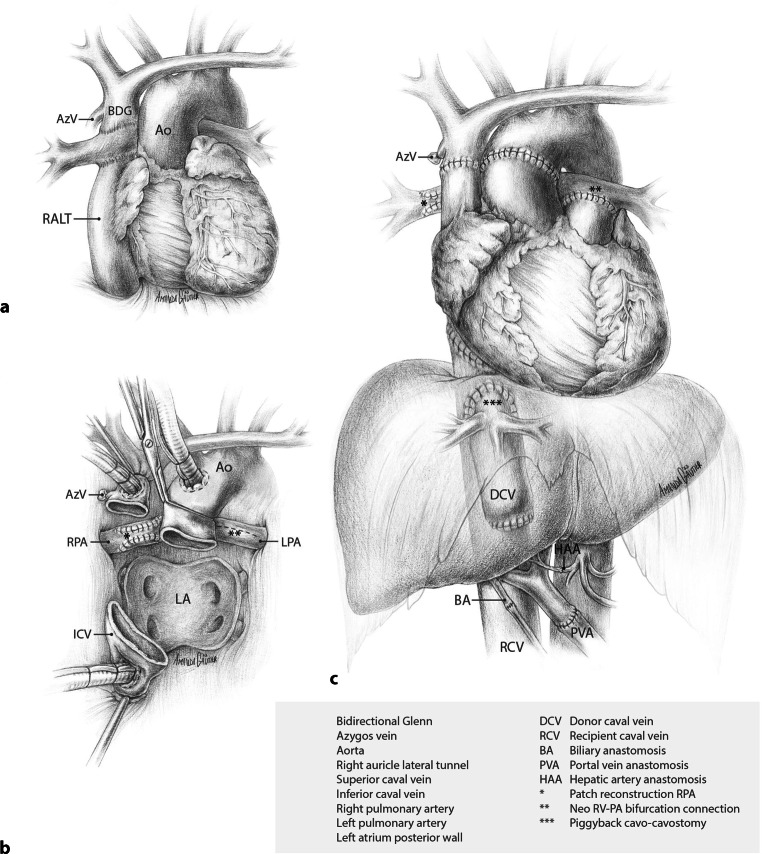 Initial experience with combined heart-liver transplantation in the Netherlands: Exploring the boundaries of isolated and combined transplantation.