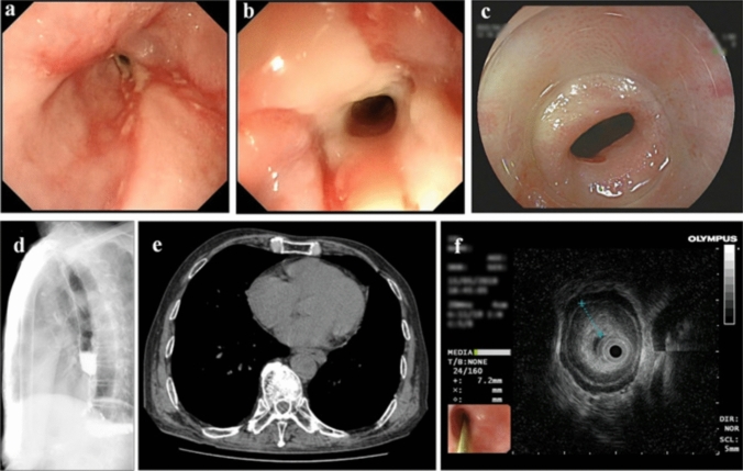 Long-Term Efficacy of Repeated Endoscopic Incision Combined with Triamcinolone Injection in Patients with Recurrent Benign Esophageal Stricture.