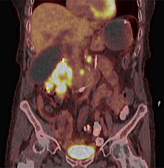 Double Endoscopic Bypass: A Durable Solution to Pair With Improving Systemic Therapy for Metastatic Cancer.