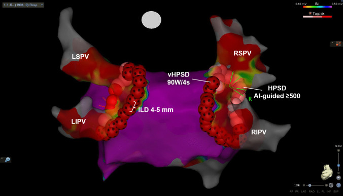 Optimized workflow with hybrid (very) high-power short-duration radiofrequency ablation renders point-by-point pulmonary vein isolation as fast and effective as cryoballoon ablation.