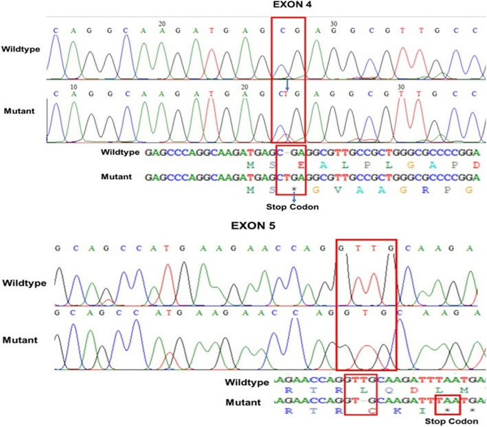 RUNX1 alterations and survival outcomes in AML: leukocyte dynamics and thrombocytosis insights from an Indonesian cohort.