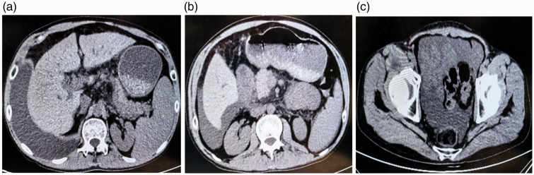 Management of chylous pleural and peritoneal effusions in a cirrhotic patient: A case report and review of literature.