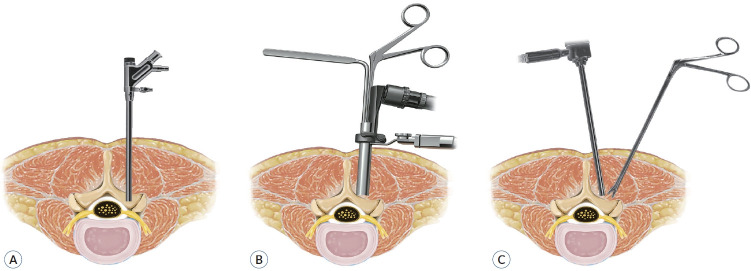 Full-Endoscopic Spine Surgery : Its Roles and Limitations.