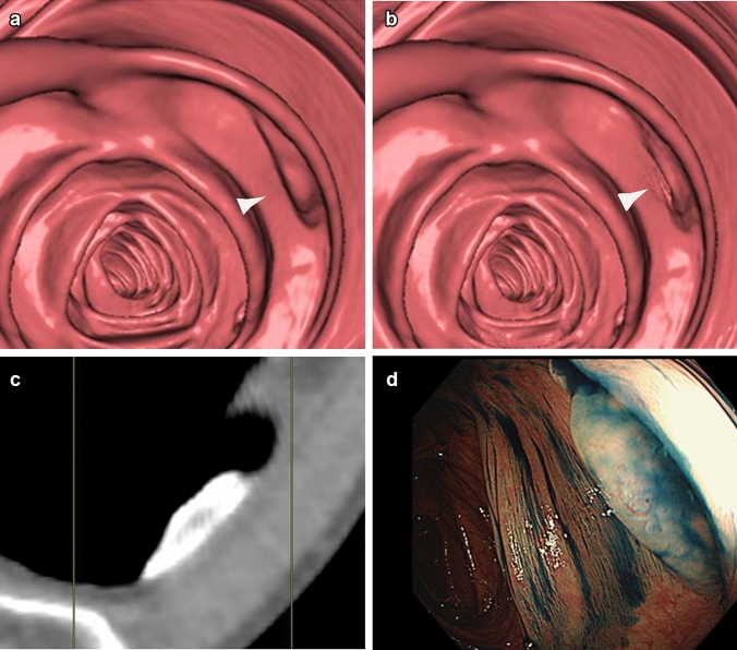 The potential of CT colonography for colorectal cancer screening in Japan.
