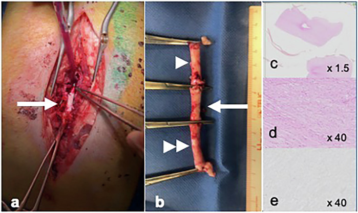 Electrochemotherapy of spinal metastasis using transpedicular approach: a preclinical safety animal study.
