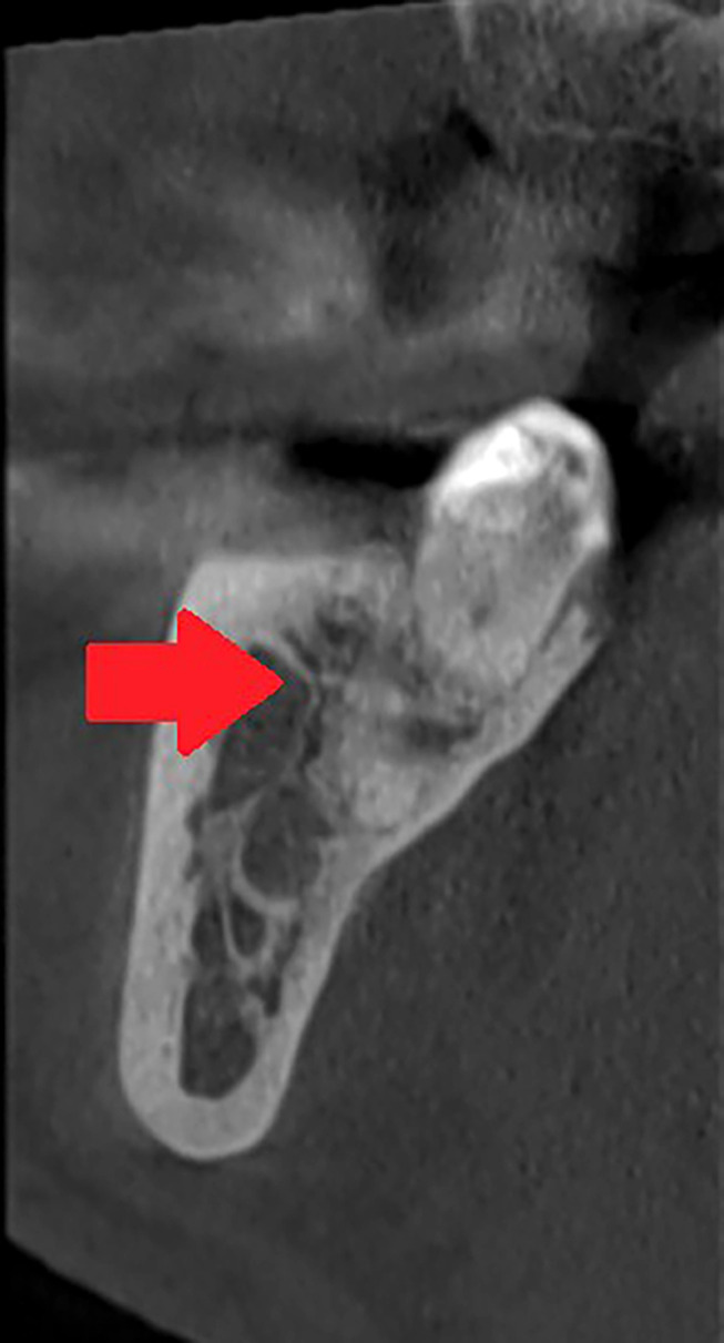 The Real Anatomy of Mandibular Canal: "New Features and Prospectives in Oral and Maxillofacial Surgery".