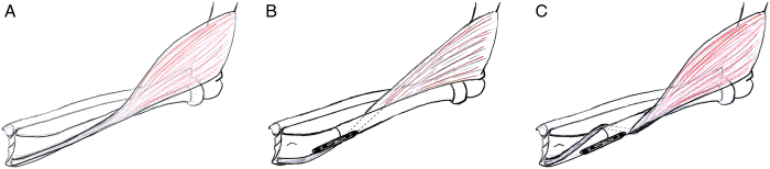 A New Technique of Brachioradialis Tendon Rerouting Combined With Osteotomy in Contractures of the Forearm.
