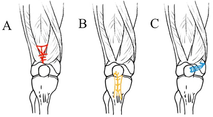 4in1 Procedure in Treating Congenital Dislocation of Patella in Children.