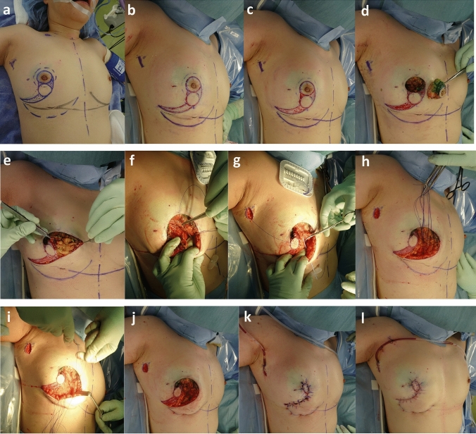 Oncoplastic breast-conserving surgery using a modified Grisotti's flap for a patient with central breast cancer in a non-ptotic breast.