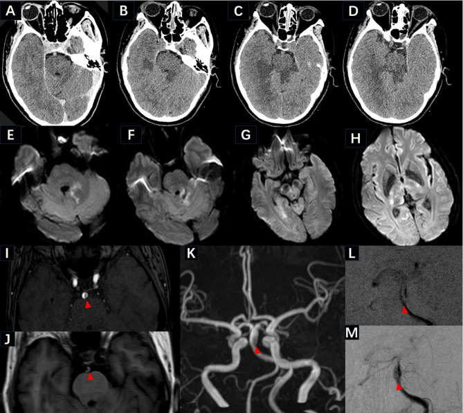 Safety and outcome of intravenous thrombolysis in ischemic stroke related to intracranial artery dissection.