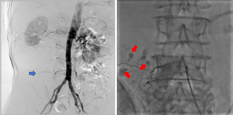Transcatheter arterial embolization for retroperitoneal bleeding in patients with lumbar artery injury and essential thrombocythemia: a case description.