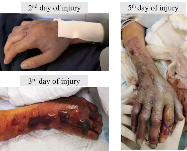 Severe Acute Bacterial Skin and Skin Structure Infection Following Fish Spine Injury: A Case Report and Literature Review.