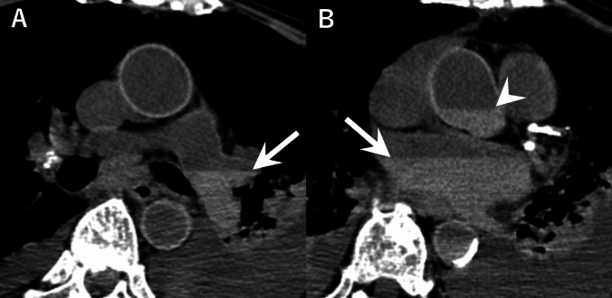 Postmortem computed tomography assessment of intracardiac and intravascular blood clots and gravitational sedimentation: clinical and laboratory associations in 114 in-hospital deaths.