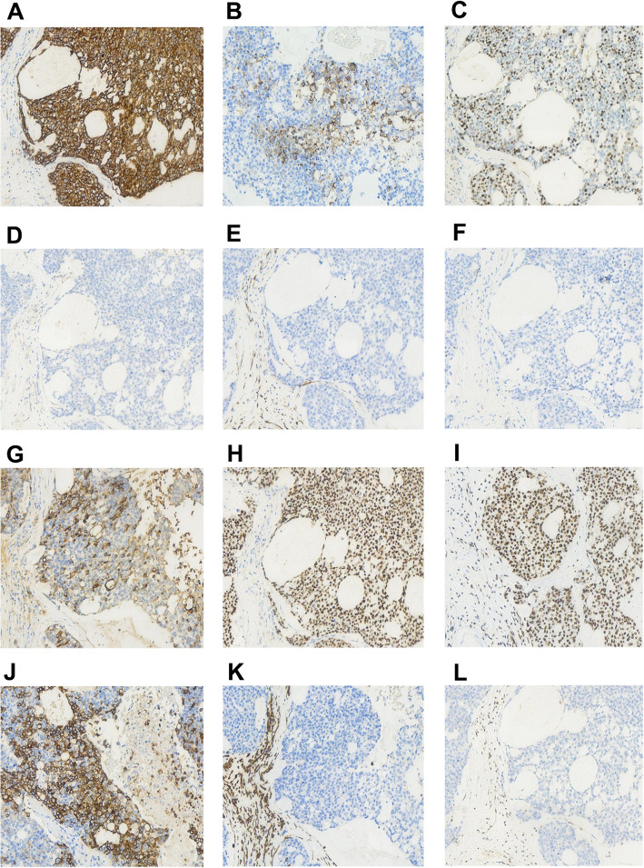 SMARCB1 (INI1)-deficient sinonasal carcinoma with yolk sac differentiation, a case of long-term clinical remission after multiple rounds of radiotherapy-a case report and literature review.