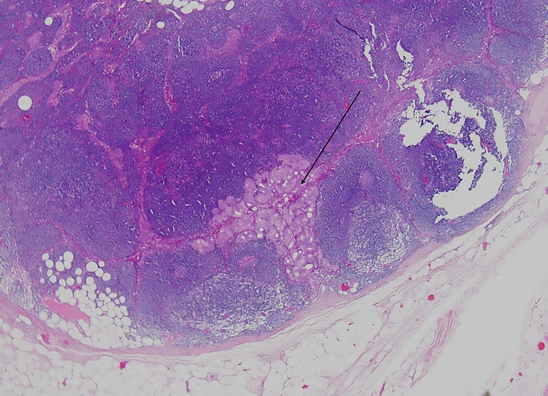 The relevance of nomograms for prediction of pelvic lymph node metastases in the prostate-specific membrane antigen (PSMA)-PET/CT era.