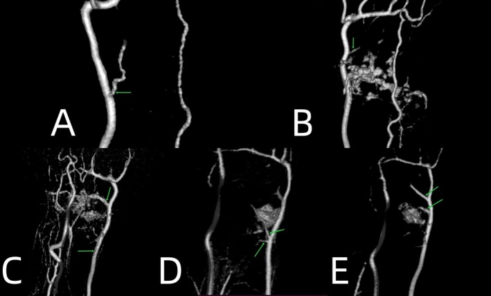 The Analysis of Magnetic Resonance Imaging on the Intra- and Extra-Osseous Blood Supply After Scaphoid Fractures.