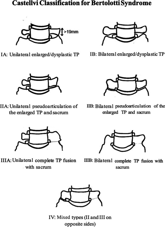 Bertolotti Syndrome in the Pediatric Population: A Literature Review and Management Algorithm.