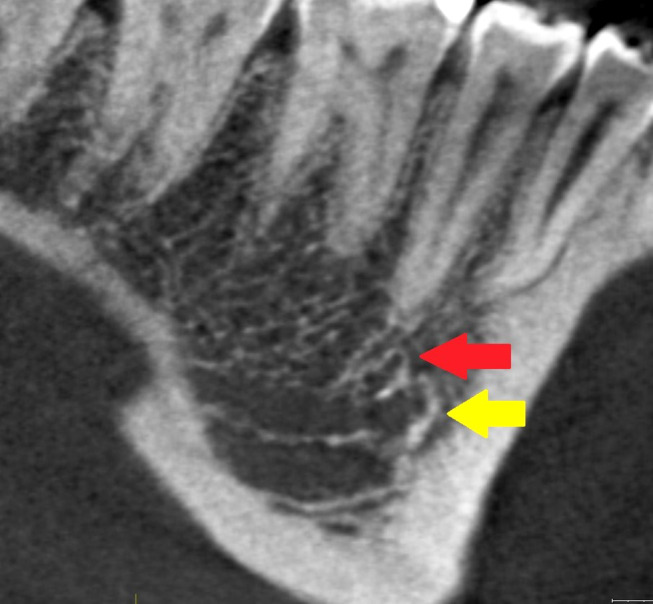 The Real Anatomy of Mandibular Canal: "New Features and Prospectives in Oral and Maxillofacial Surgery".