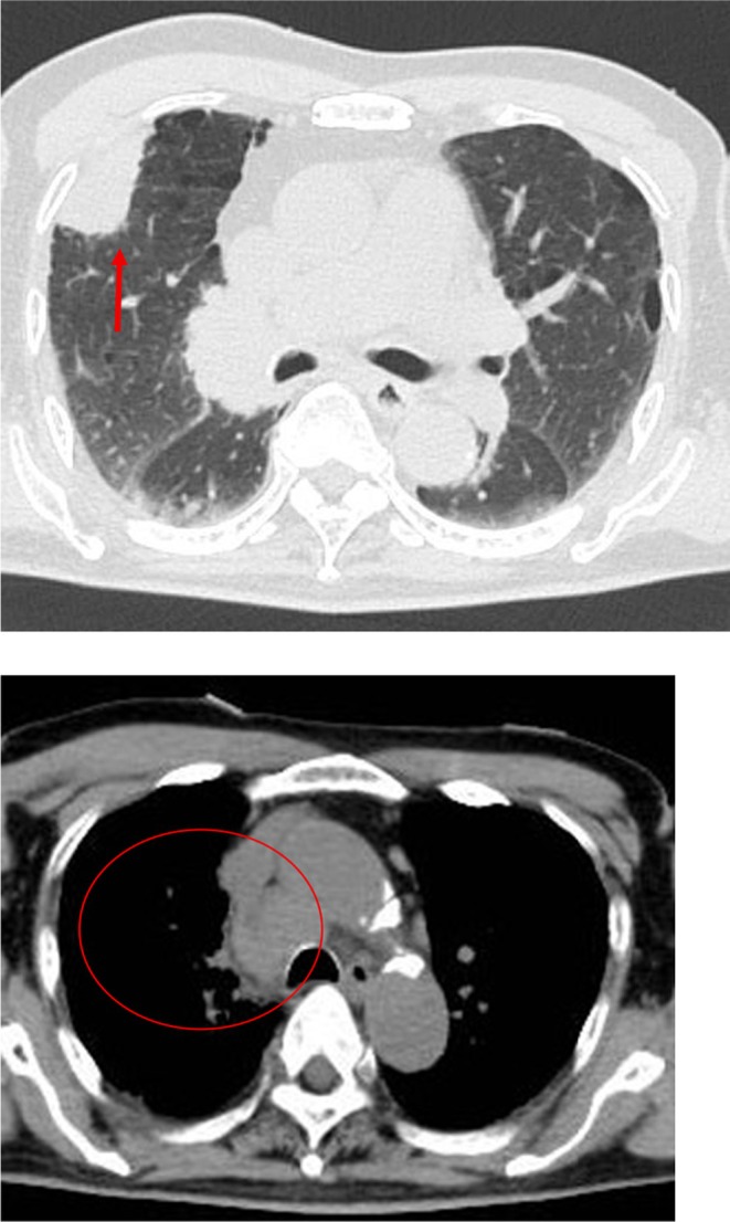 Successful Early Treatment of Anti-N-Methyl-d-Aspartate Receptor Encephalitis Associated With Small Cell Lung Cancer in an Elderly Male Patient: A Case Report.