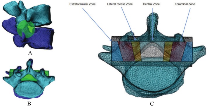 Evaluation of Indirect Decompression Effect After Extreme Lateral Lumbar Interbody Fusion Using Three-Dimensional Volumetric Measurements-A Retrospective Study.