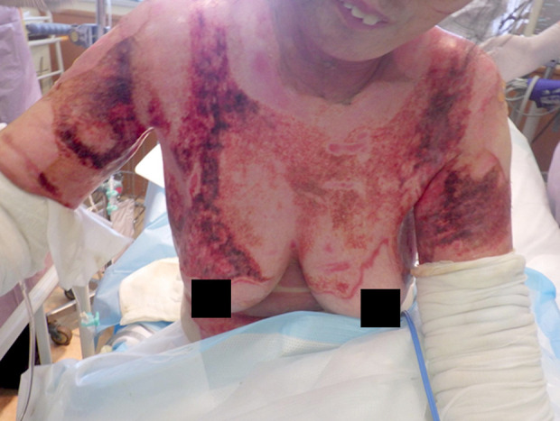 Staphylococcus-Induced Glomerulonephritis Following Burn Injury: A Case Report.