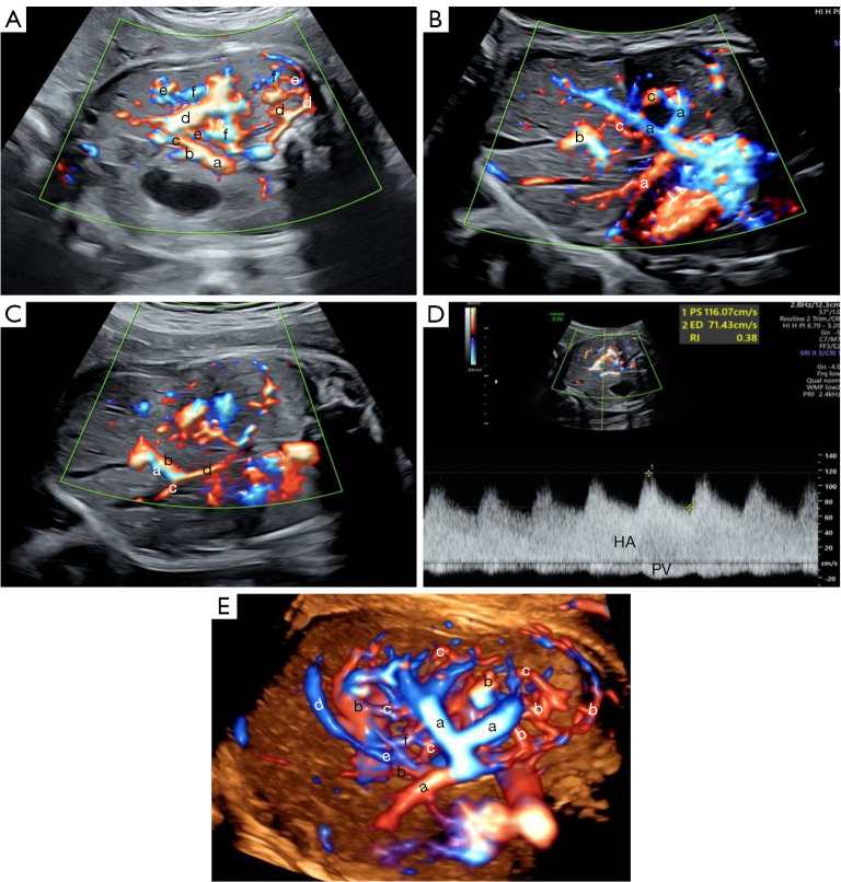Prenatal discovery of hereditary hemorrhagic telangiectasia-associated hepatic arteriovenous malformations by multimodal ultrasound and whole-exome sequencing: a rare case description and literature analysis.