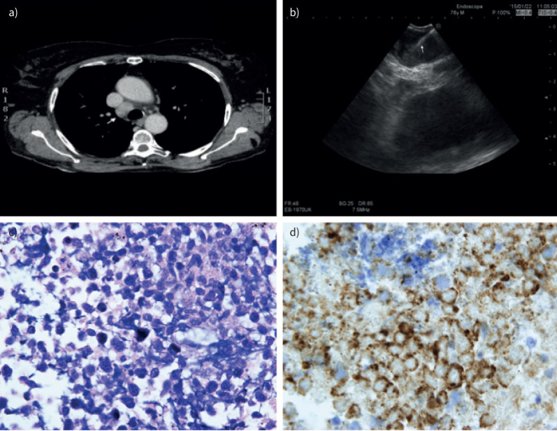 Enhancing diagnostic precision: a multicentric study of endobronchial ultrasound-guided transbronchial mediastinal cryobiopsy in lymphoproliferative disorders.