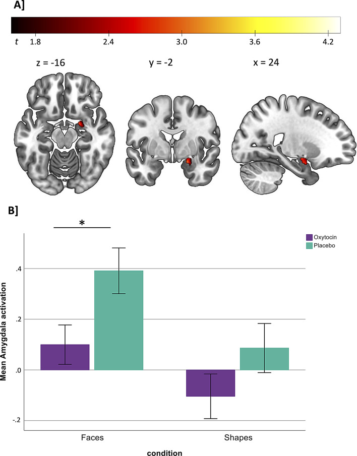 Intranasal oxytocin blunts amygdala response to negative affective stimuli in males and females with alcohol use disorder: a randomized controlled cross-over trial.