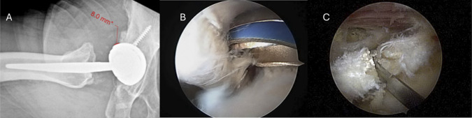 Soft-Tissue Sources of Extra-articular Pain Following Total Hip Arthroplasty: A Comprehensive Review.