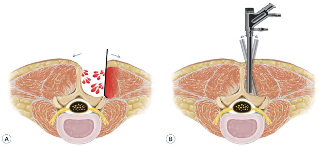 Full-Endoscopic Spine Surgery : Its Roles and Limitations.