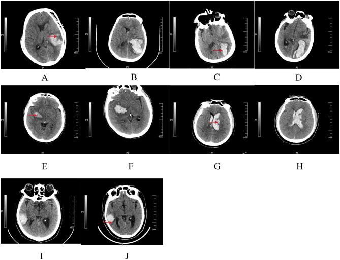 Clinical and Imaging Predictors of Hematoma Expansion in Spontaneous Intracerebral Hemorrhage: Development of a Prognostic Model.