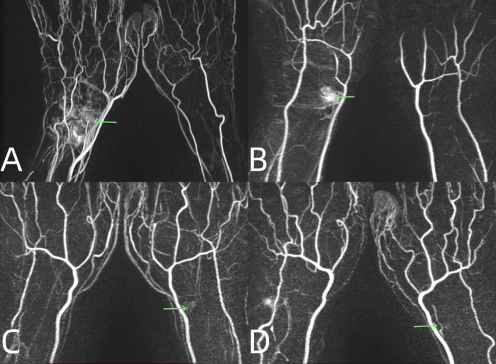 The Analysis of Magnetic Resonance Imaging on the Intra- and Extra-Osseous Blood Supply After Scaphoid Fractures.