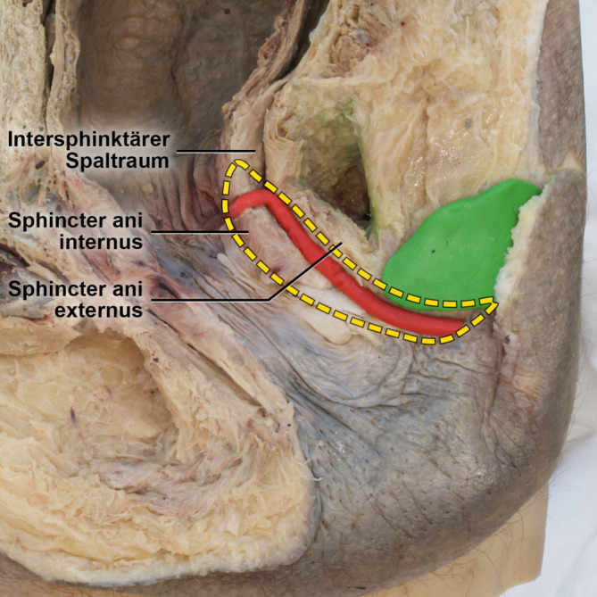 [Anal fistula disease : Anatomical foundations and surgical procedures].