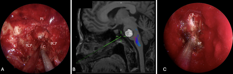 Endoscopic endonasal transclival approach for the resection of a ventral pontine cavernous malformation: illustrative case.