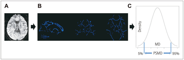 Association Between Small Vessel Disease and Migraine: A Study Based on Peak Width of Skeletonized Mean Diffusivity.