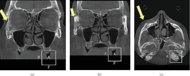Intraosseous Hemangioma of the Zygomatic Bone: A Rare Maxillofacial Case in a 57-Year-Old Woman.