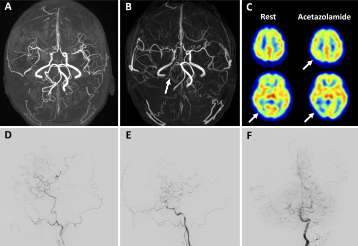 Symptomatic cerebral hyperperfusion after occipital artery-posterior cerebral artery bypass in a patient with moyamoya disease: illustrative case.