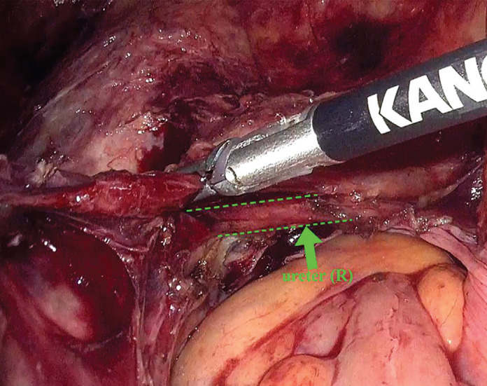 Mobilization and protection of the ureter during laparoscopic total hysterectomy for cervical fibroids.