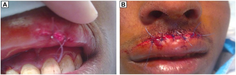 Beyond Sutures: Moist Exposed Burn Ointment (MEBO) and Scar Massage for Anatomical Restoration of Penetrating Upper Lip Laceration at the Vermilion-Cutaneous Junction in Primary Care-A Case Report.