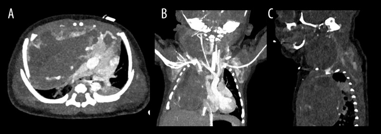Ex-Utero Intrapartum Treatment for a Fetal Cervical Teratoma with Mediastinal Extension: A Case Report.