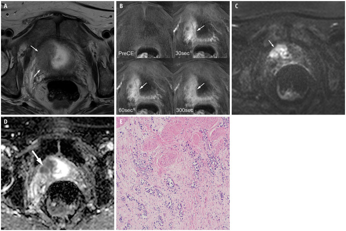 Multiparametric MRI Features of Plasmacytoid Urothelial Carcinoma of the Urinary Bladder.