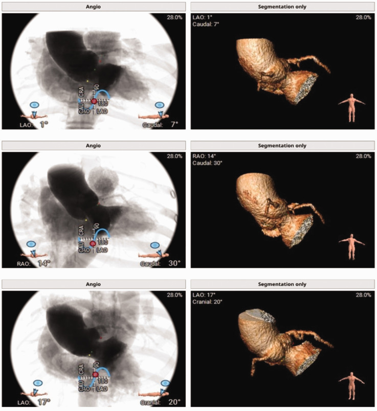 Transcatheter aortic valve implantation in a patient with isolated aortic regurgitation using JenaValve.