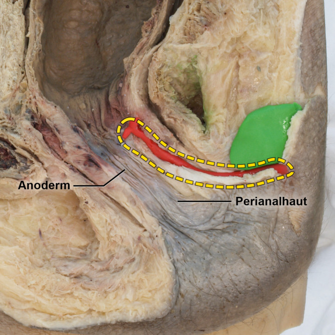 [Anal fistula disease : Anatomical foundations and surgical procedures].