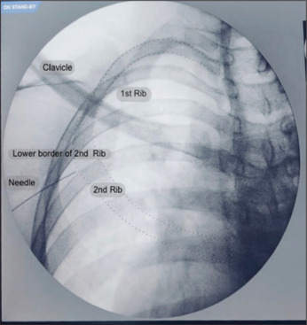 Intercostobrachial nerve block - A painful puzzle decoded.